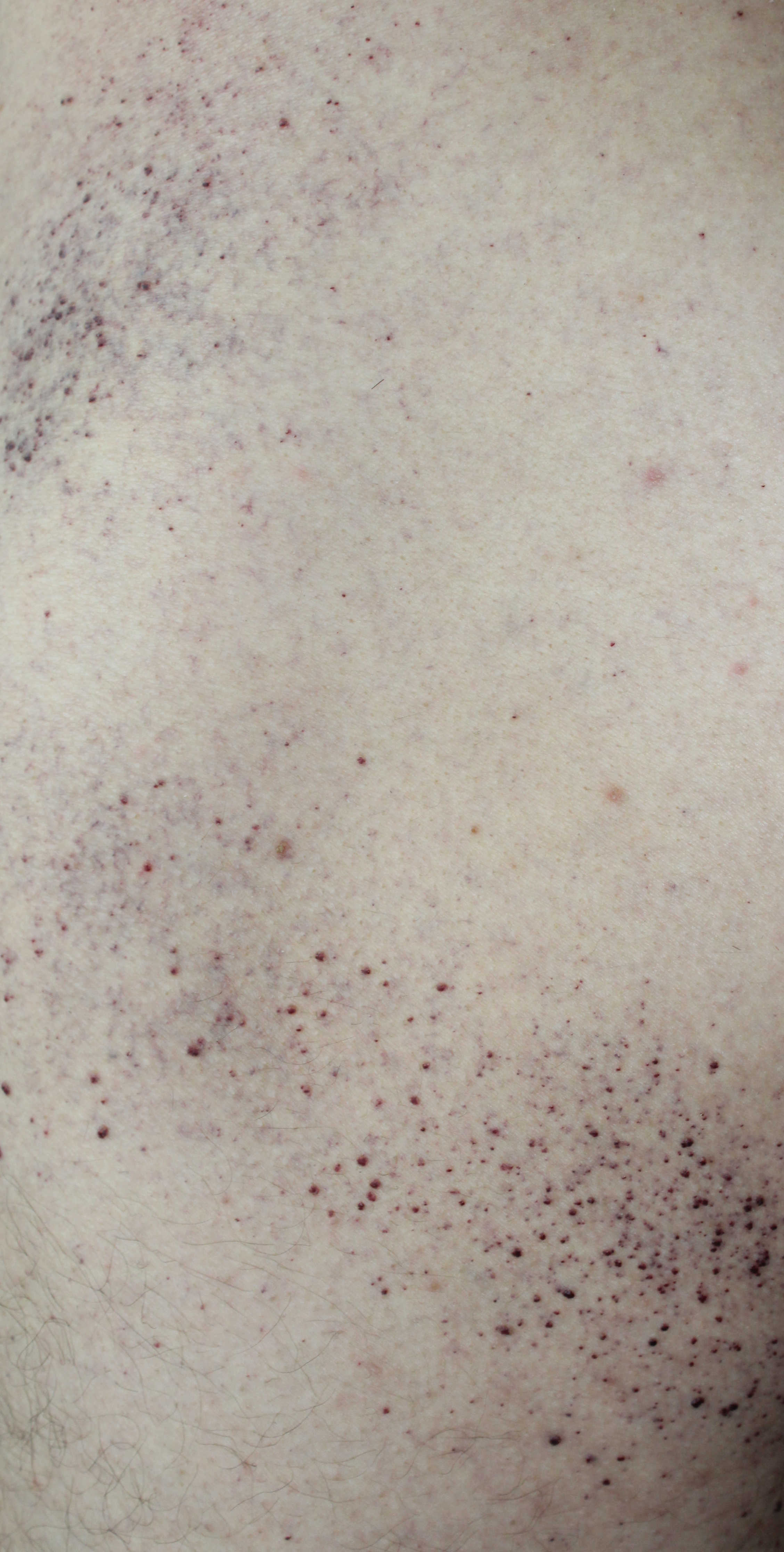 Angiokeratoma - biodro