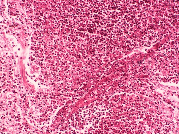 Obraz histologiczny tkanki płucnej pokazujący intensywną infiltrację eozynofilową wokół naczynia krwionośnego z martwicą włóknikową. Ilustruje to uszkodzenie tkanek spowodowane wysokim poziomem eozynofili, jak ma to miejsce w przypadku EGPA.